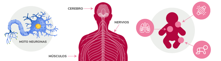 Imagen Atrofia muscular espinal