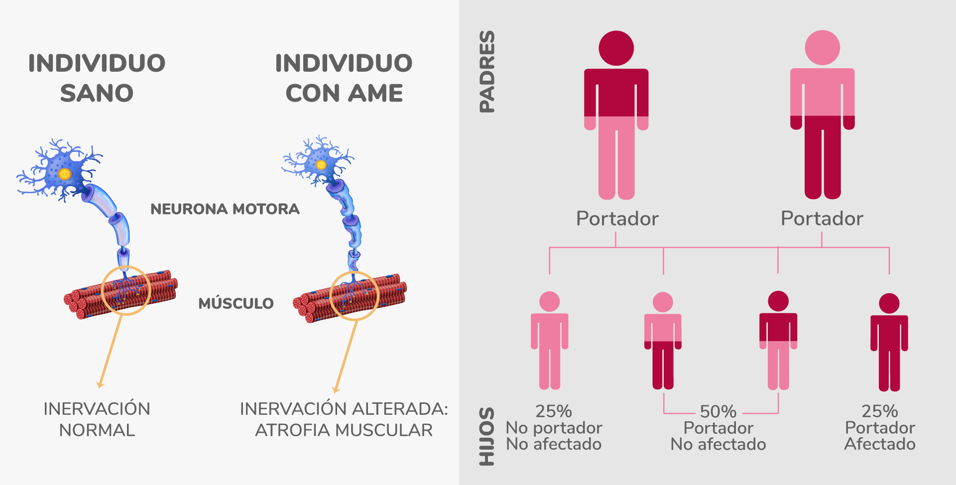 Imagen Atrofia muscular espinal